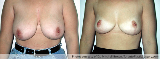 Breast Reduction, Before and After 1 Year