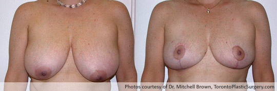 Breast Reduction, Before and After 6 Months