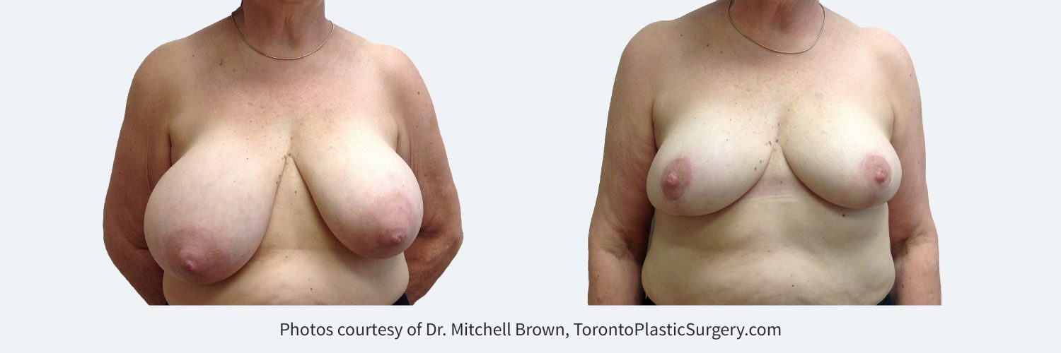 Breast Reduction, Before and 1 Year After