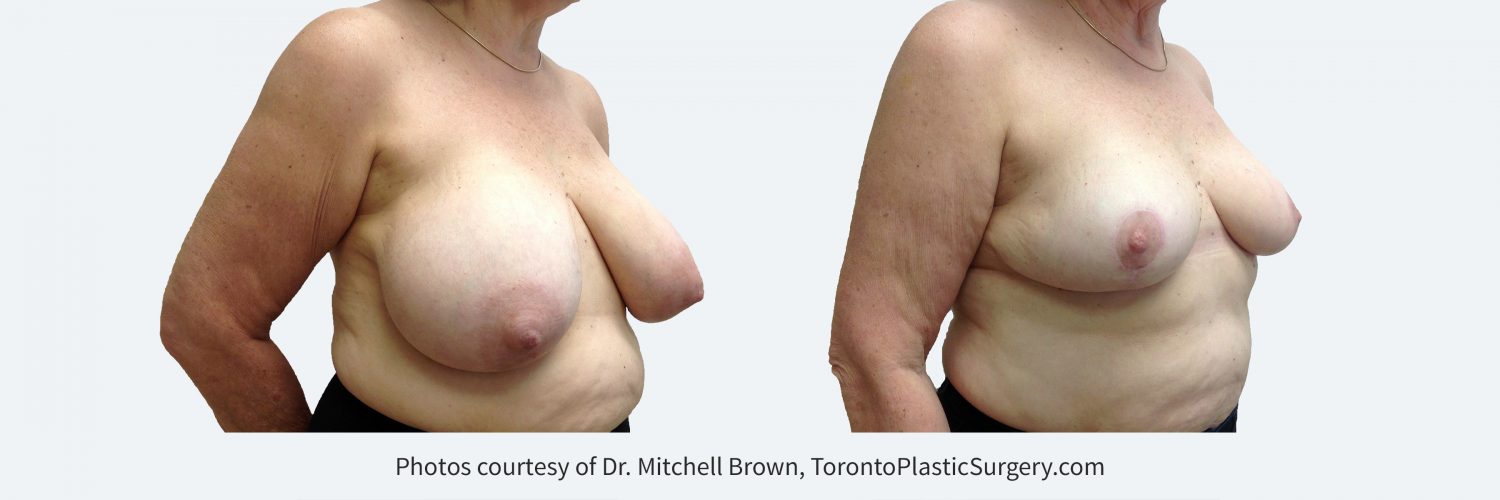 Breast Reduction, Before and 1 Year After