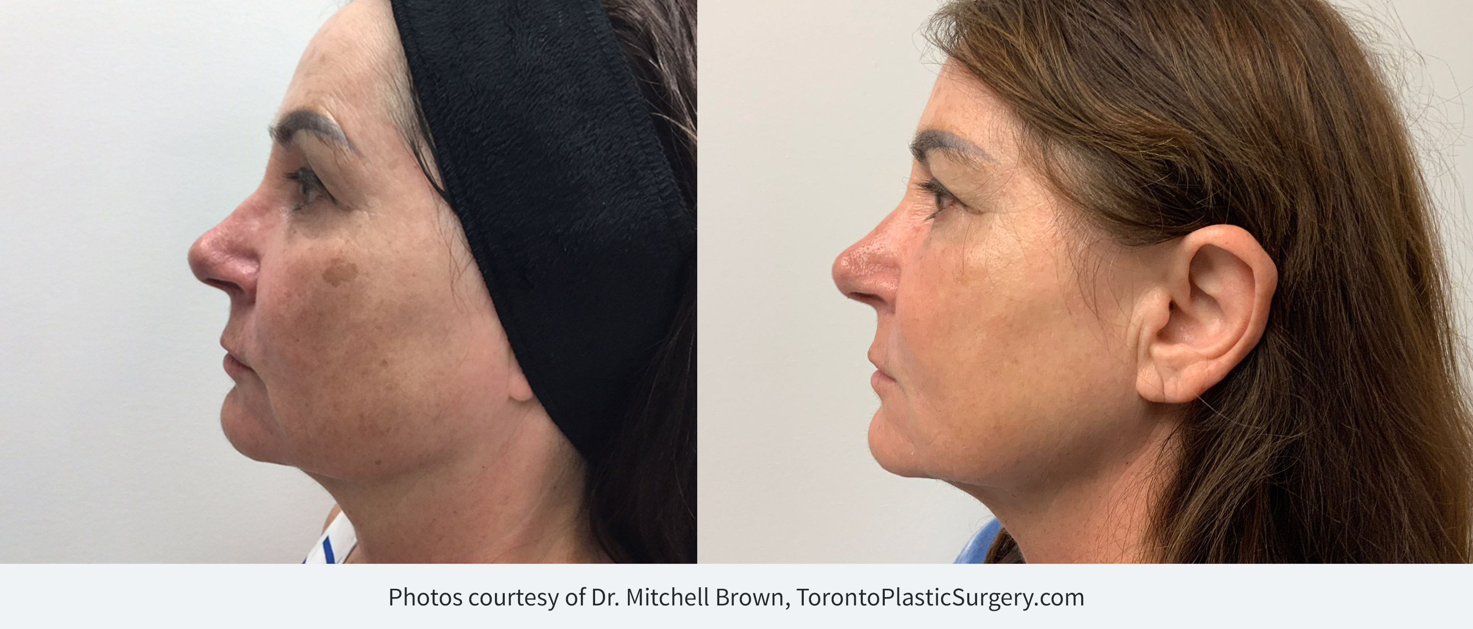 Before and After BBL/IPL treatment