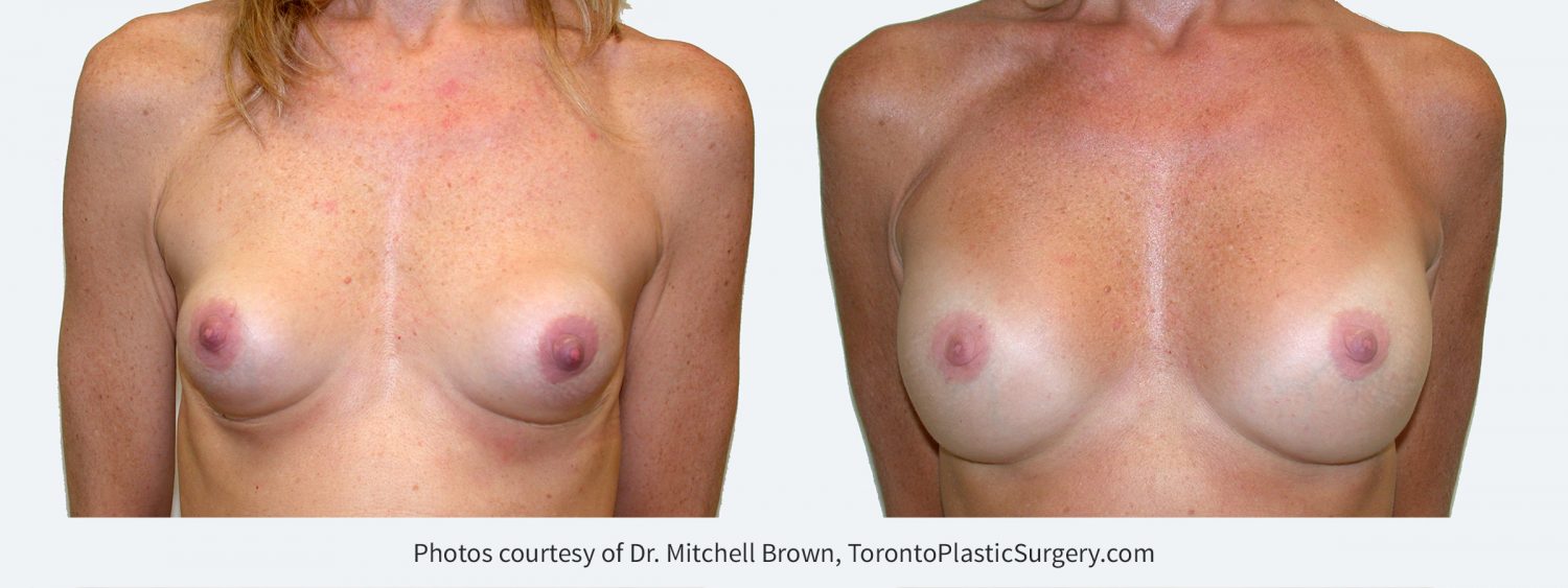 Capsular contracture (scar tissue around implants) corrected with implant removal, scar tissue removal and placement of new 275 cc silicone gel breast implants under the pectoral muscle