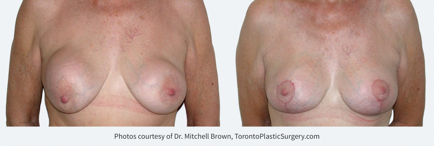 Recurrent capsular contracture treated with implant removal, scar tissue removal, replacement of new silicone gel implants under the pectoral muscle and breast lift. Before and 2 months after