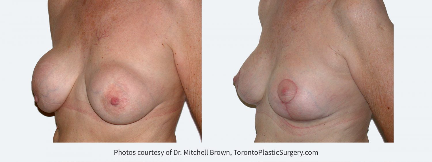 Recurrent capsular contracture treated with implant removal, scar tissue removal, replacement of new silicone gel implants under the pectoral muscle and breast lift. Before and 2 months after