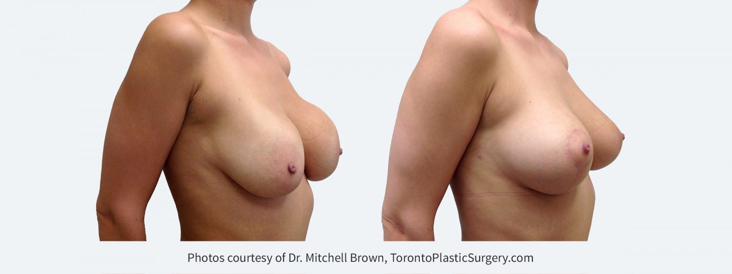 Recurrent capsular contracture on the left and implant rupture on the right treated with implant removal, scar tissue removal, replacement of new silicone gel implants under the pectoral muscle and breast lift. Before and 3 months after