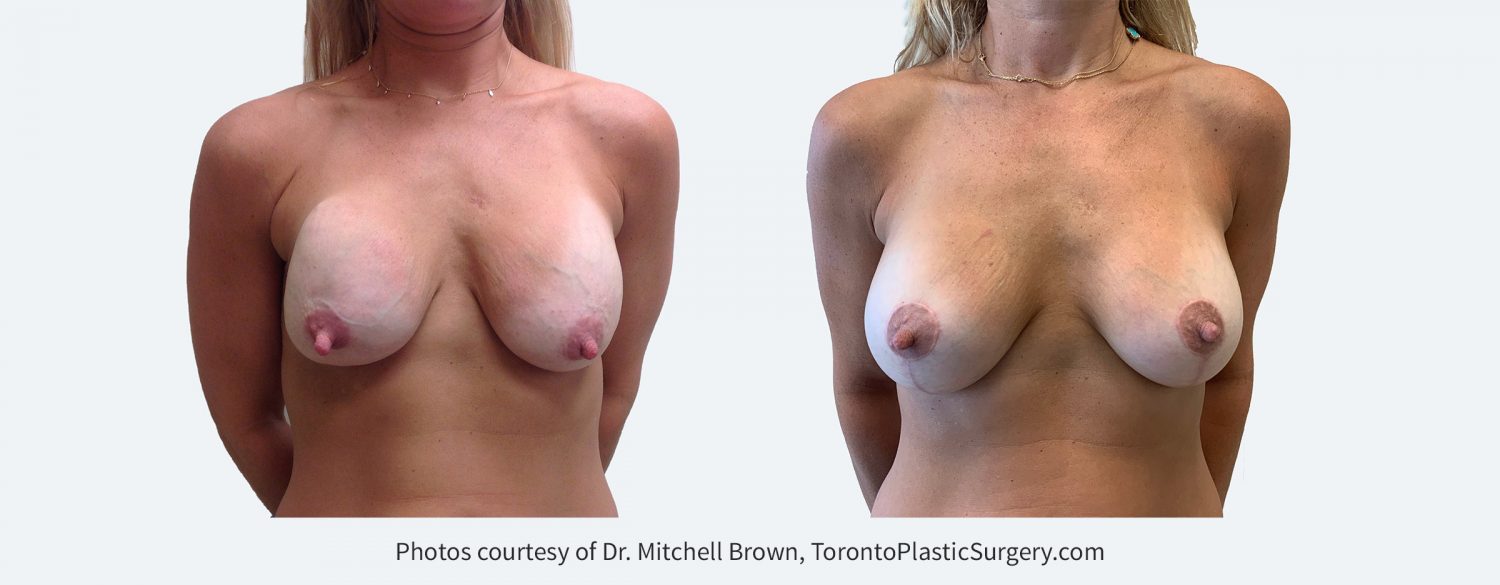 Capsular contracture (scar tissue around implants) and ptosis (sagging) 13 years following breast augmentation. Corrected with removal of old implants and scar tissue, replacement of new 330cc round silicone gel implants under the muscle along with a breast lift. Before and 6 months after.