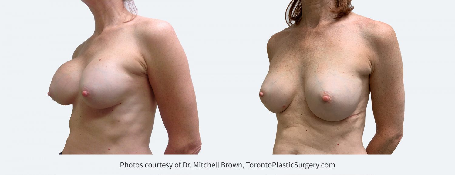 Capsular contracture fifteen years following breast augmentation with anatomic-shaped silicone gel breast implants. Treated with removal of the capsule (scar tissue) and replacement with smooth round silicone gel breast implants. Before and 6 months after.