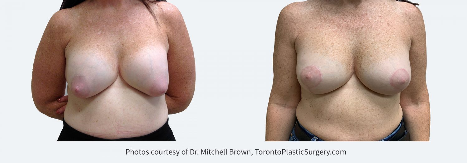 Capsular Contracture corrected with implant removal, scar tissue removal, replacement of new silicone gel 310cc implants above the pectoral muscle and breast lift. Before and 6 months after.