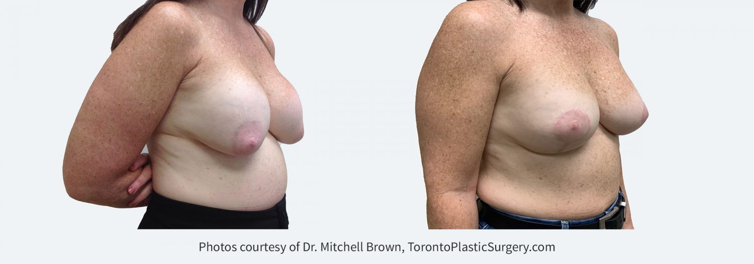 Capsular Contracture corrected with implant removal, scar tissue removal, replacement of new silicone gel 310cc implants above the pectoral muscle and breast lift. Before and 6 months after.