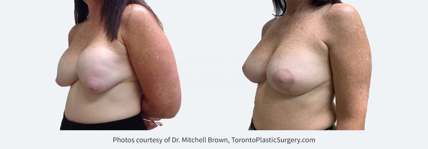 Capsular Contracture corrected with implant removal, scar tissue removal, replacement of new silicone gel 310cc implants above the pectoral muscle and breast lift. Before and 6 months after.