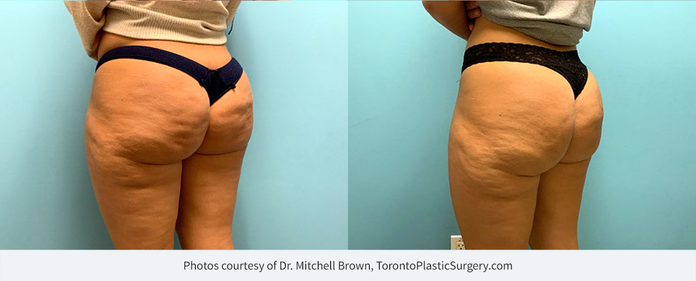 Cellulite Treatment - Cellfina  Victoria Park Medispa - Montreal