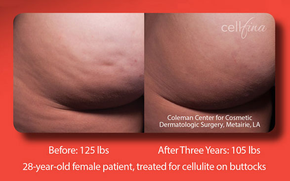 Cellfina® - Cellulite Treatment