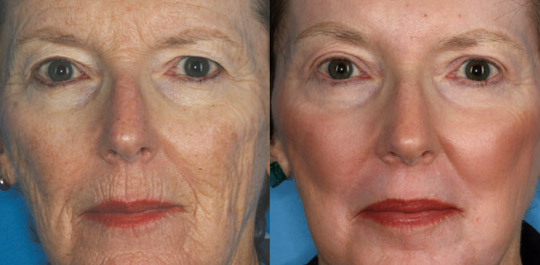 Deep Resurfacing with Laser Skin Peel, Before and After