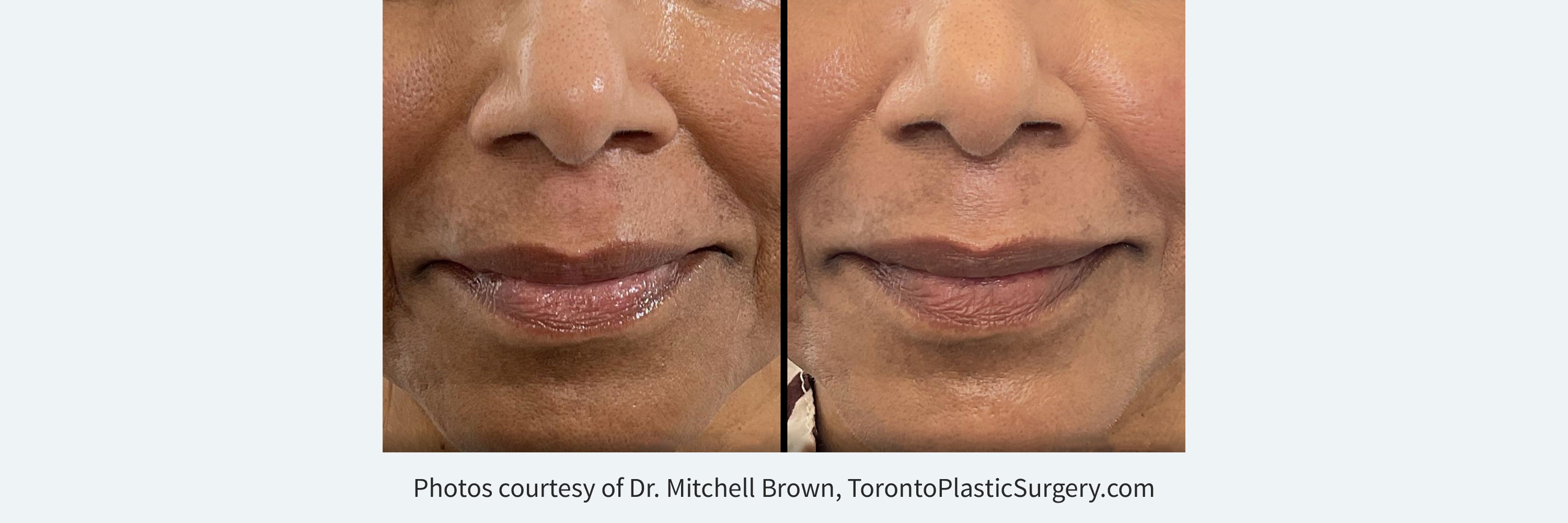 Derm-eclat Melasma and Hyperpigmentation TreatmentBefore and After a single treatment