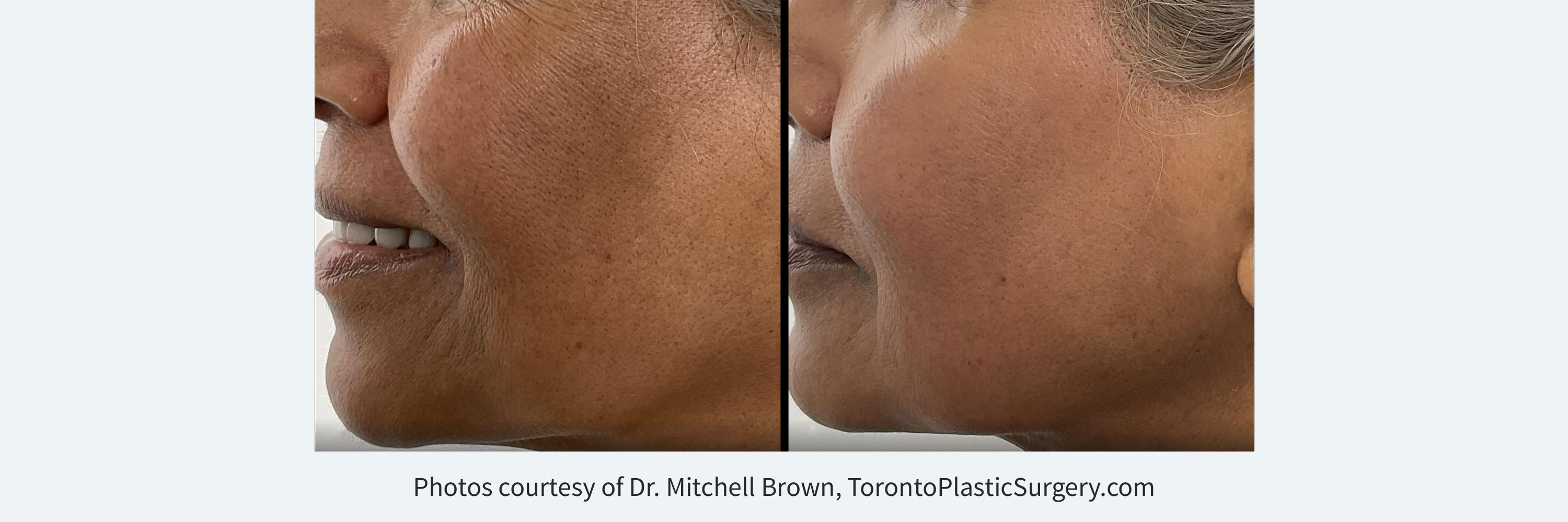 Derm-eclat Melasma and Hyperpigmentation TreatmentBefore and After a single treatment
