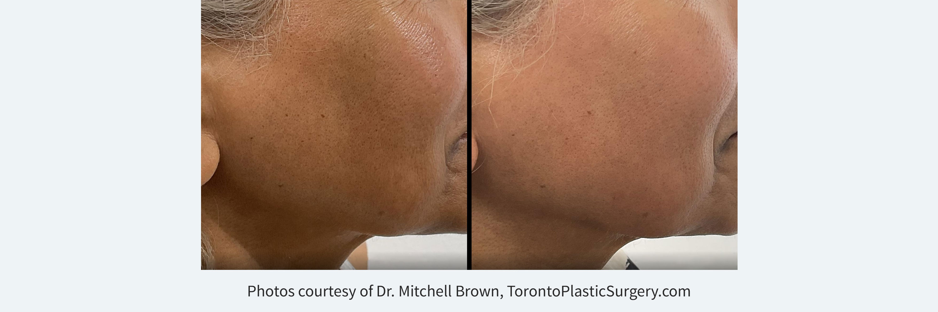 Derm-eclat Melasma and Hyperpigmentation TreatmentBefore and After a single treatment