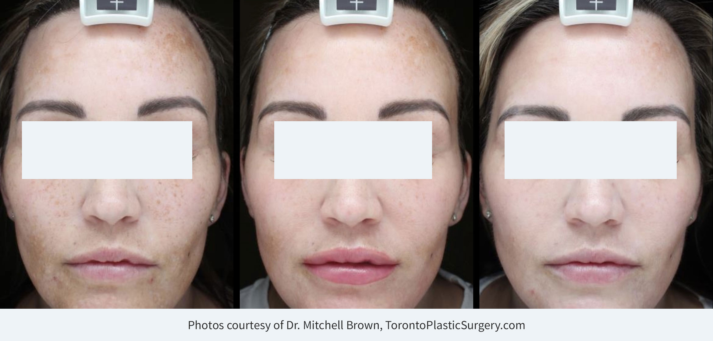 Derm-eclat Melasma and Hyperpigmentation TreatmentBefore/day of treatment start (left), after 2 week touch-up (middle), 1 month post treatment (right).
