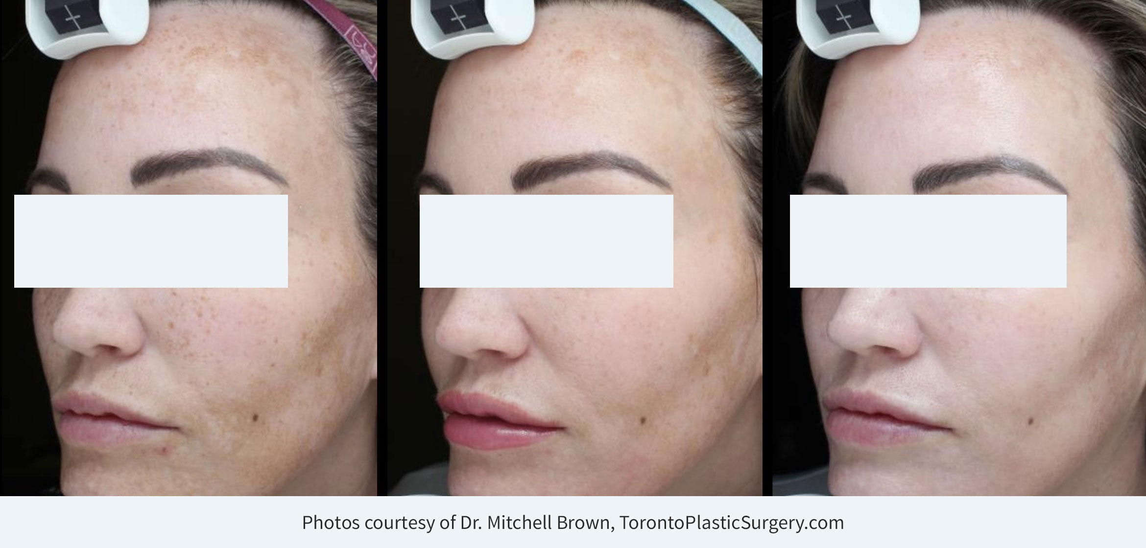 Derm-eclat Melasma and Hyperpigmentation TreatmentBefore/day of treatment start (left), after 2 week touch-up (middle), 1 month post treatment (right).