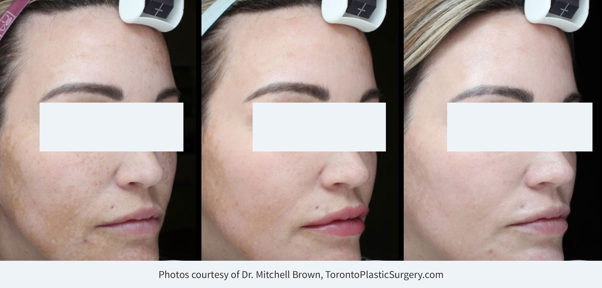 Derm-eclat Melasma and Hyperpigmentation TreatmentBefore/day of treatment start (left), after 2 week touch-up (middle), 1 month post treatment (right).