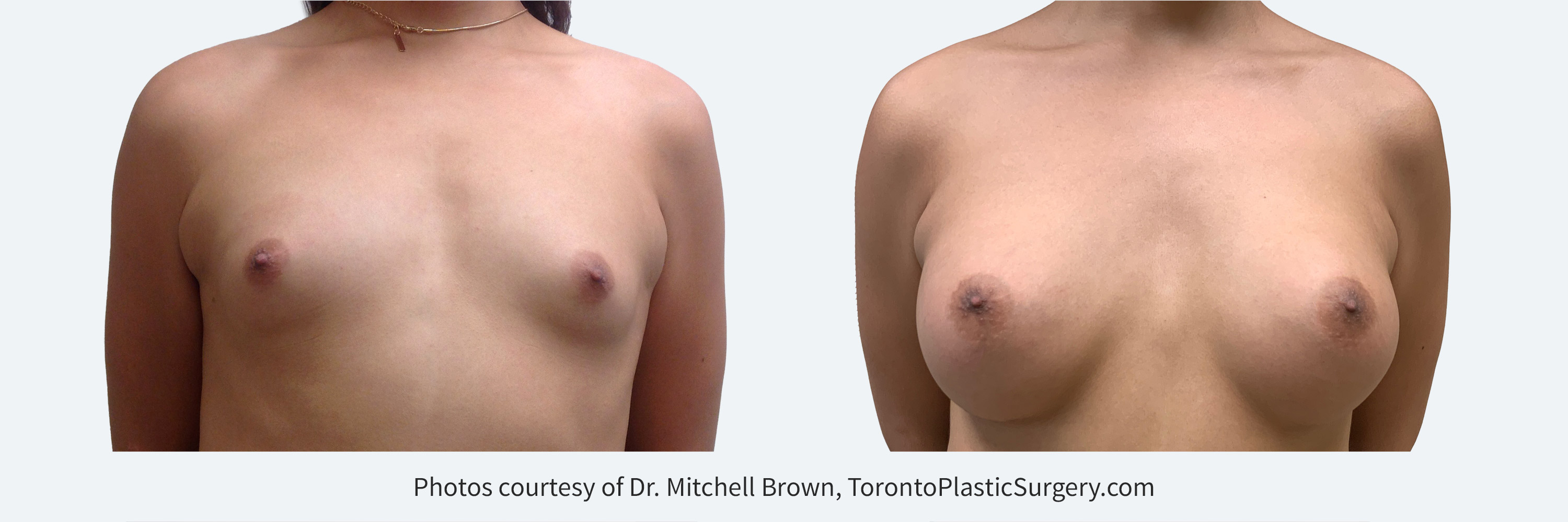 Transfemale Breast Augmentation with 485cc implants, fold incision, Before and 10 months After