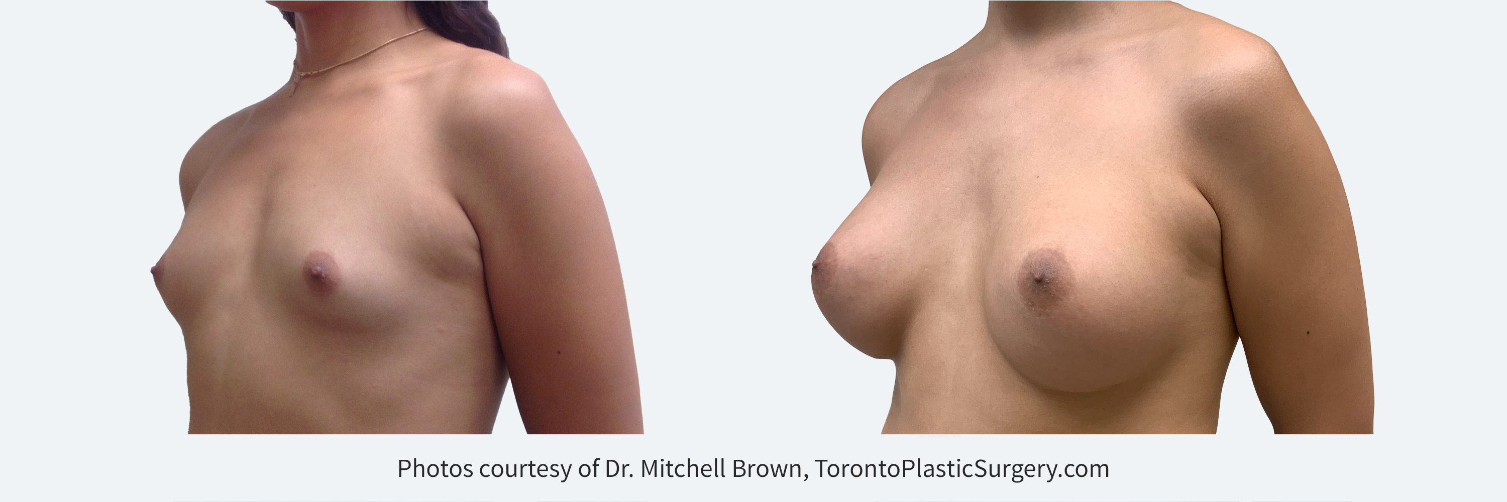 Transfemale Breast Augmentation with 485cc implants, fold incision, Before and 10 months After