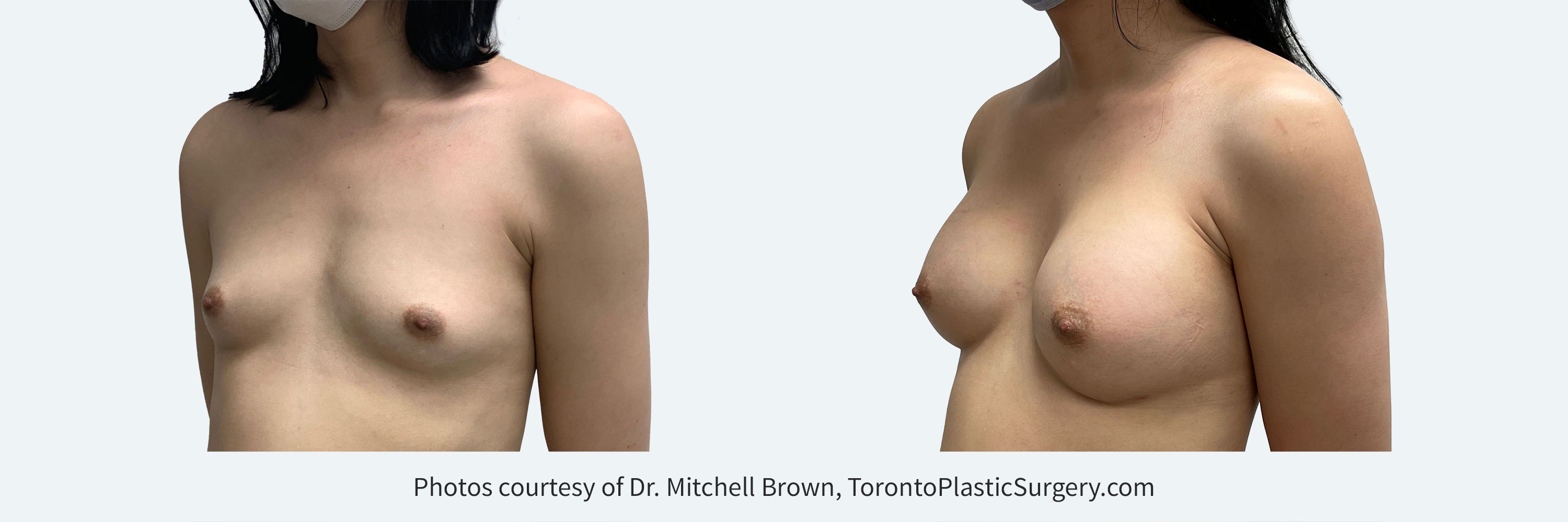 Transfemale Breast Augmentation with smooth round gel 450cc implants, Before and After 6 Months