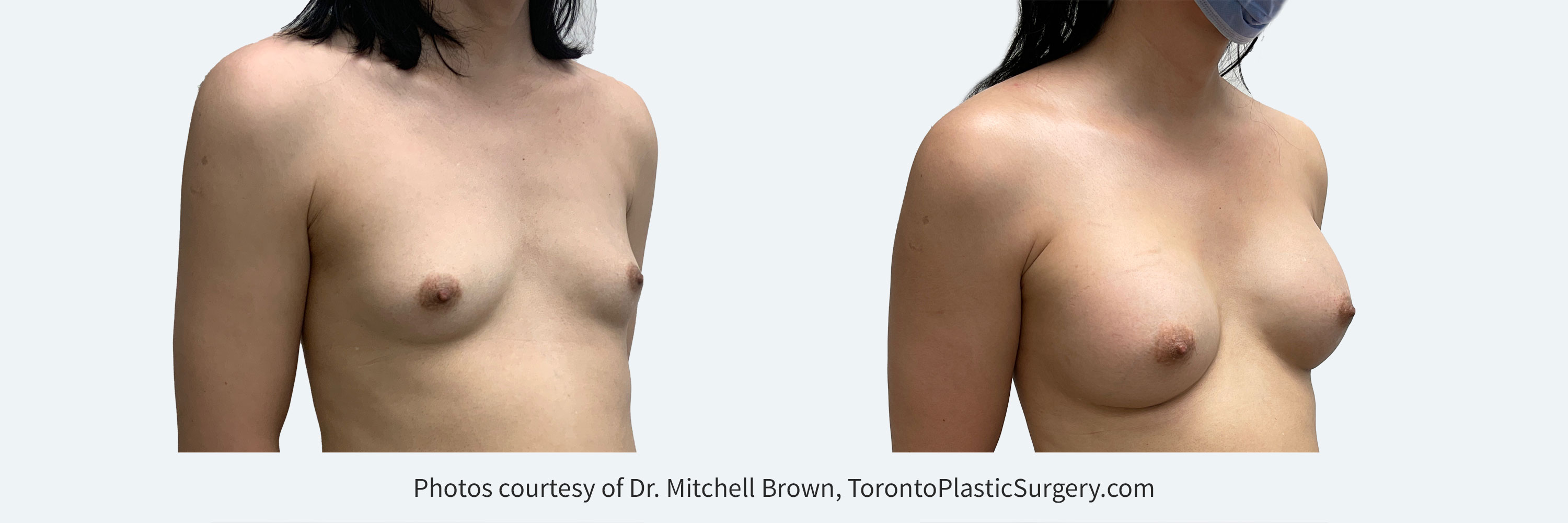 Transfemale Breast Augmentation with smooth round gel 450cc implants, Before and After 6 Months