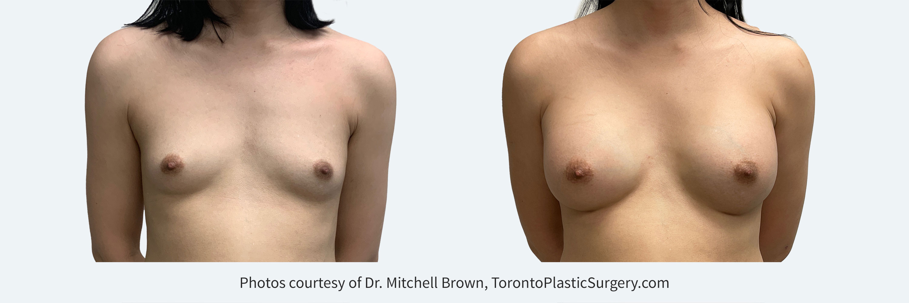 Transfemale Breast Augmentation with smooth round gel 450cc implants, Before and After 6 Months