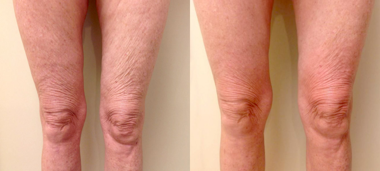 Endymed for Knees / Knee Lift: 65-year old female, before and after Endymed knee treatment