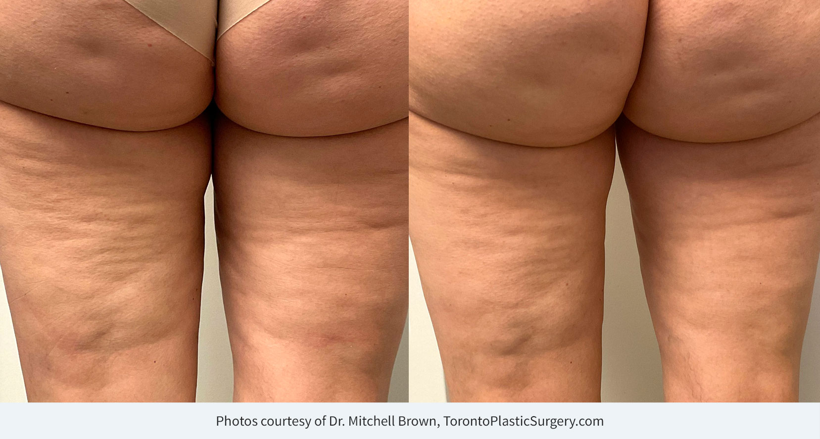 Endymed 3Deep Series 8, back of thighs treated. Before and 1 month after series completed.