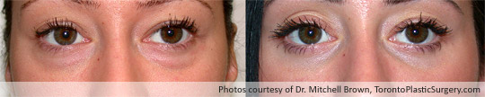 Lower Eyelid Surgery, Before and After 6 Months