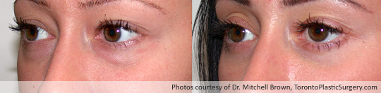 Lower Eyelid Surgery, Before and After 6 Months