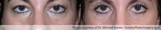 Upper and Lower Eyelid Surgery, Before and After 6 Months