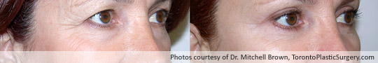 Upper and Lower Eyelid Surgery, Before and After 6 Months
