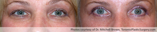 Upper and Lower Eyelid Surgery, Before and After