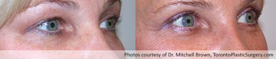 Upper and Lower Eyelid Surgery, Before and After