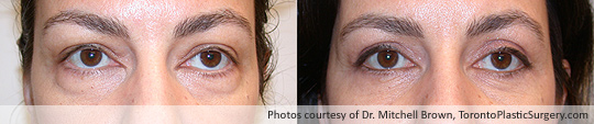 Eyelid Surgery, Before and After 6 Months