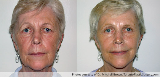 Facelift and Upper Eyelid Surgery, Before and After 6 Months