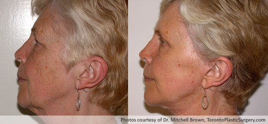 Facelift and Upper Eyelid Surgery, Before and After 6 Months
