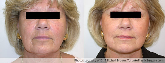 Facelift and Upper & Lower Eyelid Surgery, Before and After 6 Months
