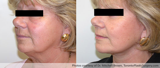 Facelift and Upper & Lower Eyelid Surgery, Before and After 6 Months