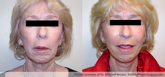 Facelift, Before and After 6 Months