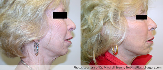 Facelift, Before and After 6 Months