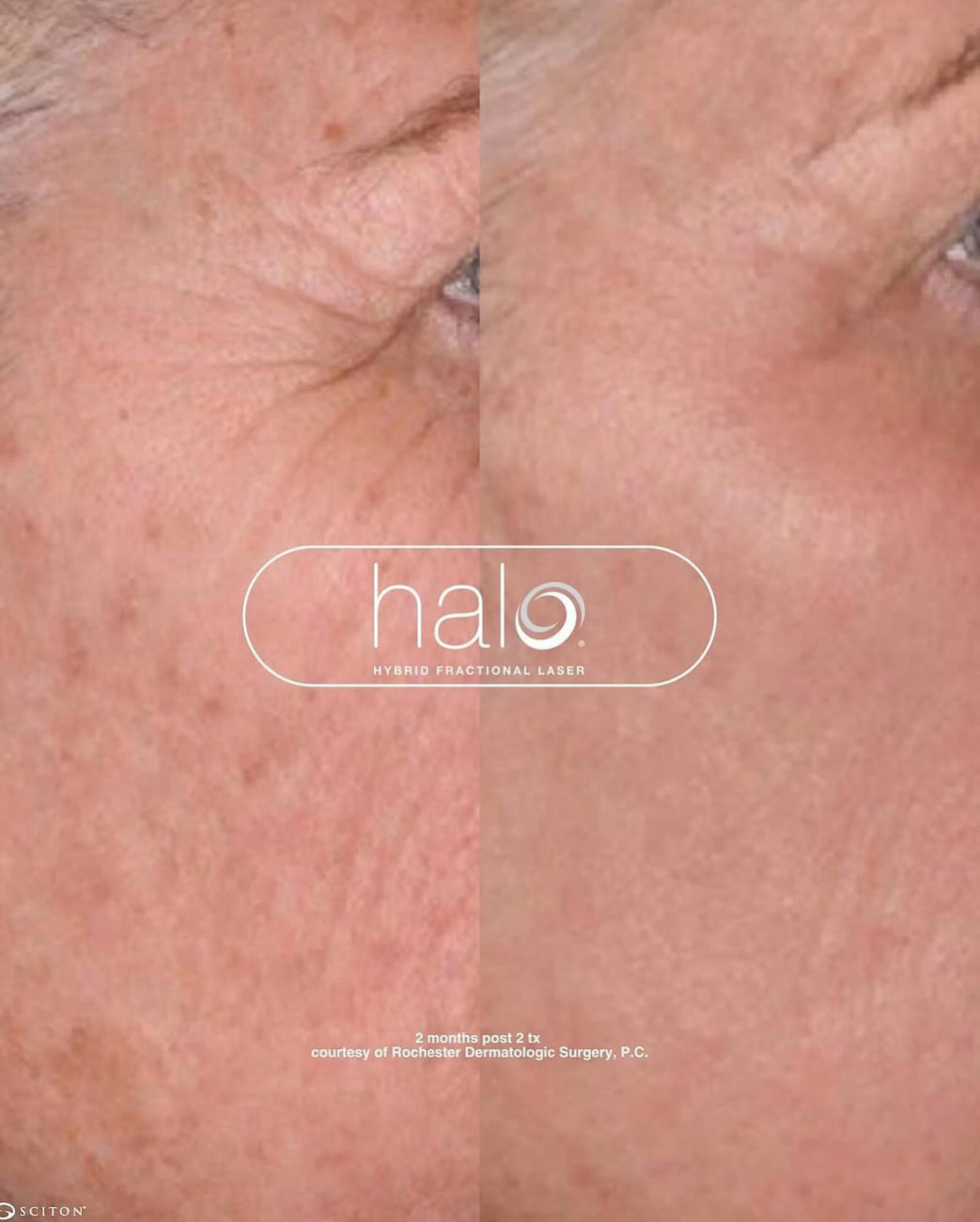 halo-laser-before-after-eye-wrinkles