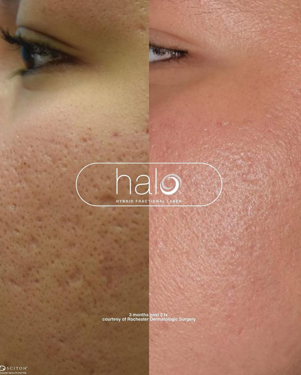 halo-laser-toronto-before-after-acne-scars