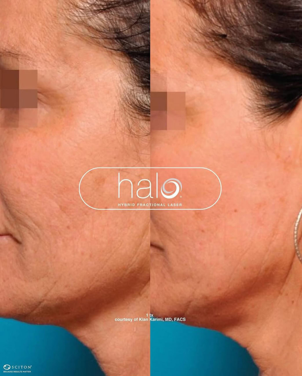 halo-laser-toronto-before-after-skin-laxity-texture-wrinkles