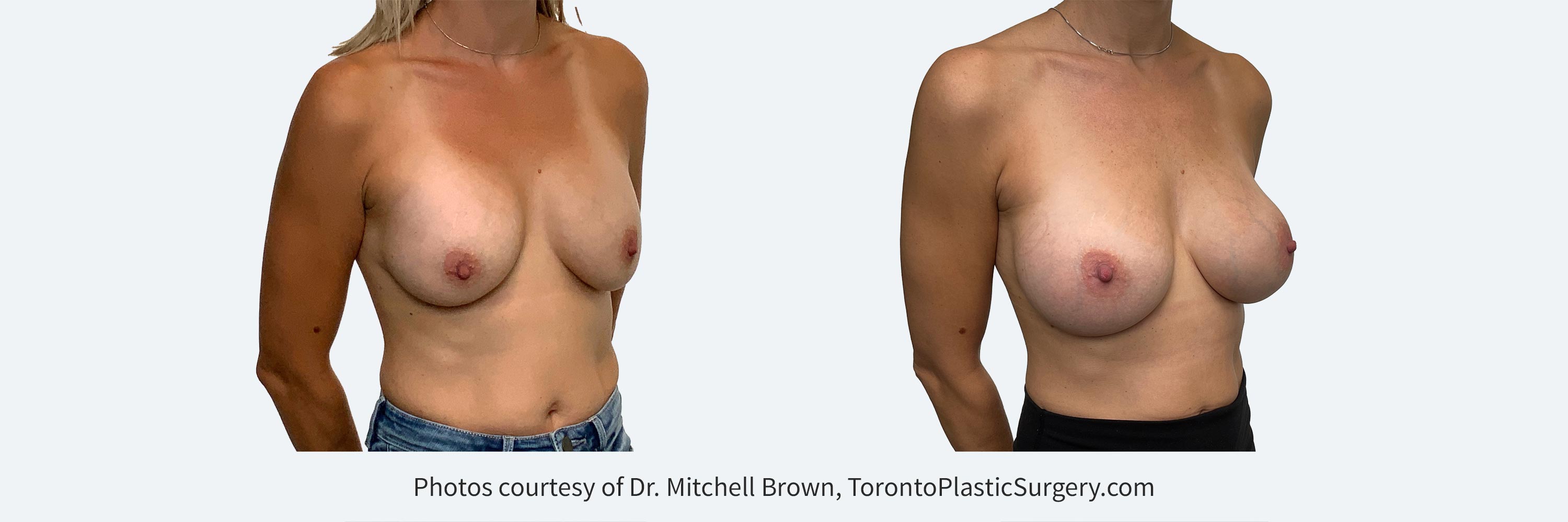 37 year female with high riding breast implants. Corrected with removal and replacement of larger 475cc implants.