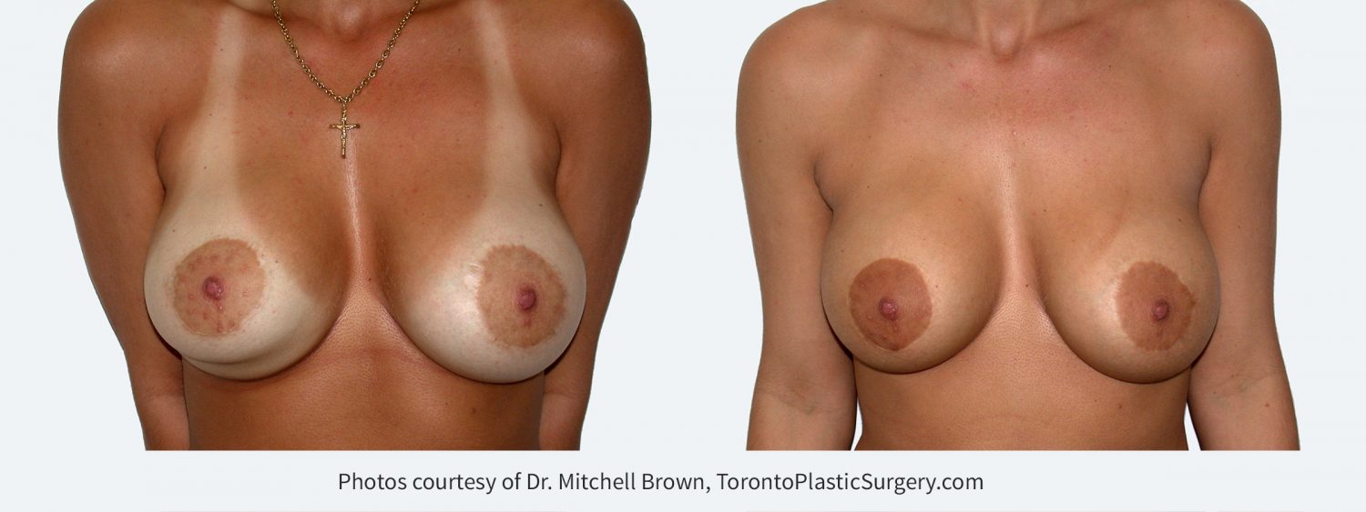 Inferior malposition of the right implant (implant too low) following breast augmentation and reduction of the areola. Right implant position corrected with internal sutures and revision of both areola scars. Before and 6 months after