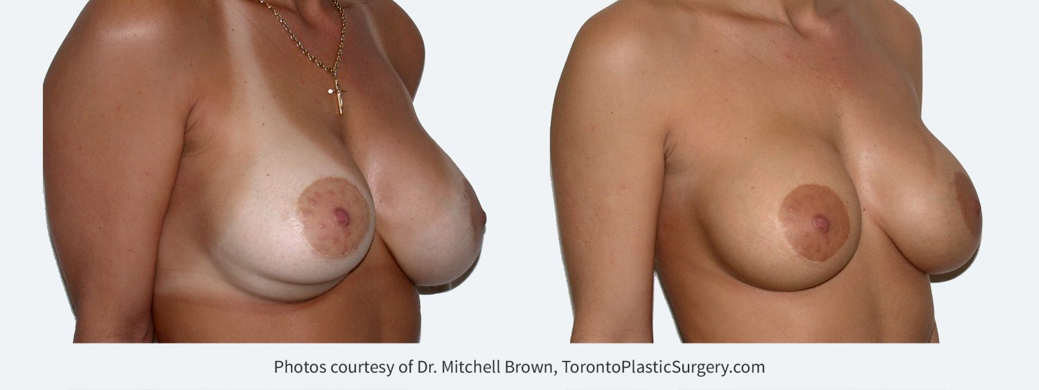 Inferior malposition of the right implant (implant too low) following breast augmentation and reduction of the areola. Right implant position corrected with internal sutures and revision of both areola scars. Before and 6 months after