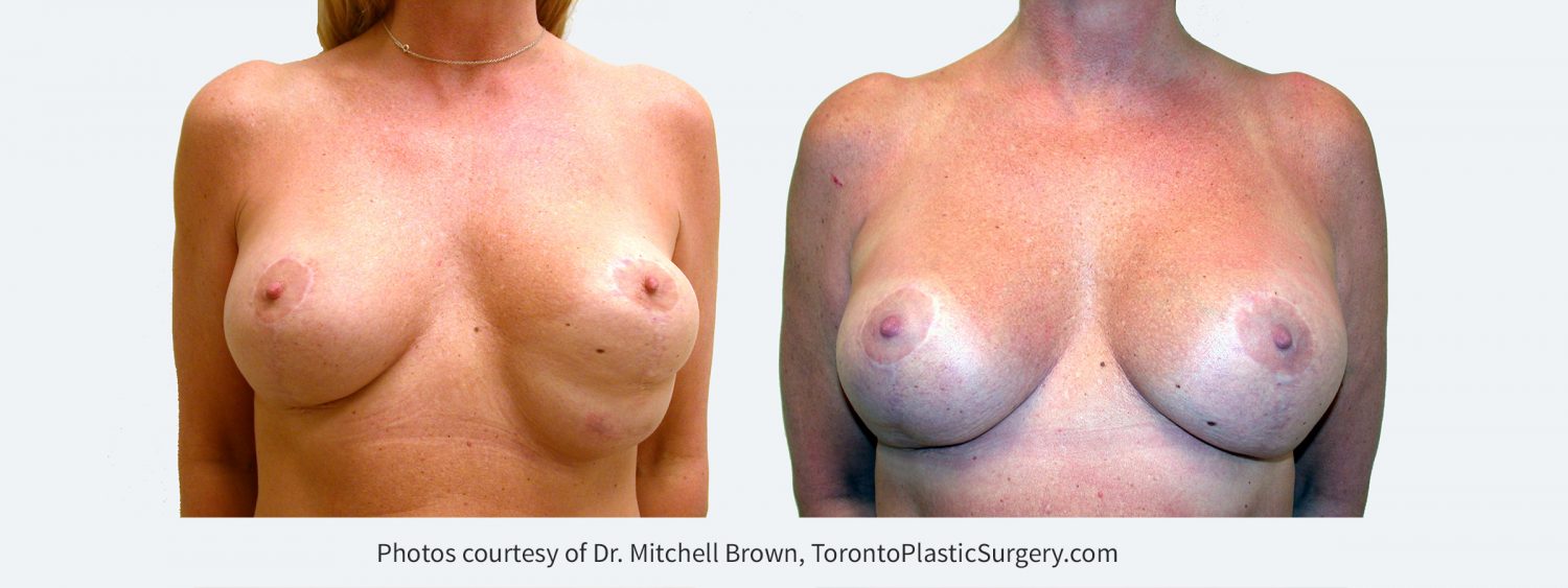 Inferior malposition of the left implant (implant too low) due to excessive release of the inframammary fold following breast augmentation and breast lift. The patient had several failed corrections. Left implant position corrected with internal sutures of the fold and insertion of an internal support matrix. Before and 6 months after